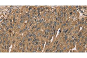 Immunohistochemistry of paraffin-embedded Human breast cancer using SCGB2A1 Polyclonal Antibody at dilution of 1:50 (SCGB2A1 anticorps)