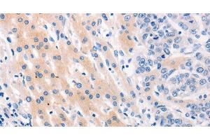Immunohistochemistry of paraffin-embedded Human lung cancer tissue using MUC2 Polyclonal Antibody at dilution 1:60 (MUC2 anticorps)