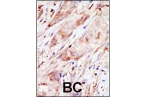 Formalin-fixed and paraffin-embedded human cancer tissue reacted with the primary antibody, which was peroxidase-conjugated to the secondary antibody, followed by AEC staining.