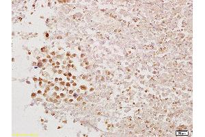 Formalin-fixed and paraffin embedded mouse tumor tissue labeled with Anti-PAX1 Polyclonal Antibody, Unconjugated (ABIN673269) at 1:200 followed by conjugation to the secondary antibody and DAB staining. (PAX1 anticorps  (AA 151-250))
