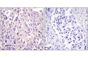 Immunohistochemistry analysis of paraffin-embedded human breast carcinoma tissue, using UBE1L Antibody. (UBA7 anticorps  (AA 963-1012))