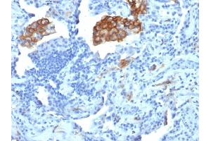 Formalin-fixed, paraffin-embedded human Lung Carcinoma stained with CD209 Mouse Monoclonal Antibody (C209/1781). (DC-SIGN/CD209 anticorps)