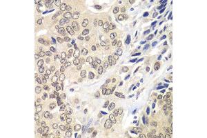 Immunohistochemistry of paraffin-embedded human prostate cancer using RNF2 antibody.