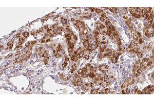 ABIN6278465 at 1/100 staining Human liver cancer tissue by IHC-P. (GABRA1 anticorps  (Internal Region))