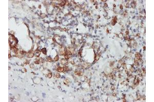 Immunoperoxidase of monoclonal antibody to STAT4 on formalin-fixed paraffin-embedded human ovary, clear cell carcinoma tissue.