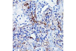 Immunohistochemistry of paraffin-embedded human lung cancer using CD105/Endoglin Rabbit mAb (ABIN7266938) at dilution of 1:100 (40x lens).