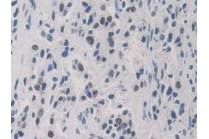 Detection of HNRNPA1 in Human Prostate cancer Tissue using Polyclonal Antibody to Heterogeneous Nuclear Ribonucleoprotein A1 (HNRNPA1)
