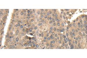 Immunohistochemistry of paraffin-embedded Human liver cancer using TXN Polyclonal Antibody at dilution of 1:40 (TXN anticorps)