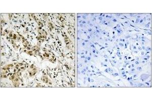 Immunohistochemistry analysis of paraffin-embedded human breast carcinoma tissue, using CtBP1 (Ab-422) Antibody. (CTBP1 anticorps  (AA 388-437))