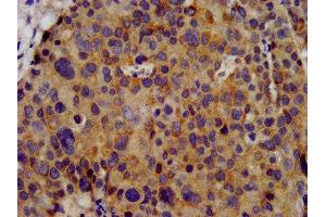 IHC image of ABIN7163969 diluted at 1:300 and staining in paraffin-embedded human pancreatic cancer performed on a Leica BondTM system. (KCNC3 anticorps  (AA 638-745))
