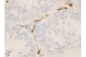 Immunohistochemical staining of ROCK2 on formalin fixed, paraffin embedded human intestinal cancer with ROCK2 polyclonal antibody .