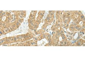 Immunohistochemistry of paraffin-embedded Human thyroid cancer tissue using TENT5C Polyclonal Antibody at dilution of 1:110(x200) (FAM46C anticorps)