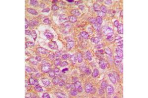 Immunohistochemical analysis of IKK beta (pY188) staining in human breast cancer formalin fixed paraffin embedded tissue section. (IKBKB anticorps  (pTyr188))