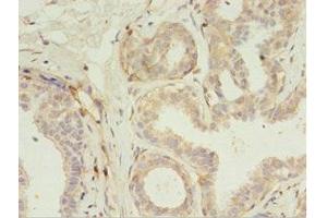 Immunohistochemistry of paraffin-embedded human breast cancer using ABIN7167192 at dilution of 1:100 (RERG anticorps  (AA 1-199))