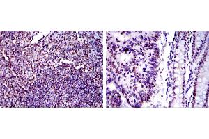 Immunohistochemical analysis of paraffin-embedded human tonsil tissues (left) and human colon cancer tissues (right) using XRCC5 mouse mAb with DAB staining.