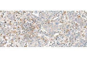 Immunohistochemistry of paraffin-embedded Human cervical cancer tissue using SLC41A3 Polyclonal Antibody at dilution of 1:35(x200) (SLC41A3 anticorps)