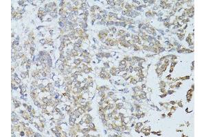 Immunohistochemistry of paraffin-embedded human colon carcinoma using TEFM antibody (ABIN5974873) at dilution of 1/100 (40x lens). (TEFM anticorps)