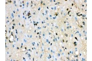 IHC-P: VCP antibody testing of human glioma tissue
