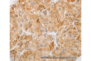 Immunohistochemistry of Human liver cancer using NGF Polyclonal Antibody at dilution of 1:40 (Nerve Growth Factor anticorps)