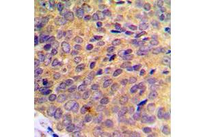 Immunohistochemical analysis of UBA7 staining in human breast cancer formalin fixed paraffin embedded tissue section.