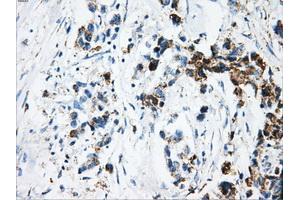 Immunohistochemical staining of paraffin-embedded Adenocarcinoma of breast tissue using anti-ATP5B mouse monoclonal antibody. (ATP5B anticorps)