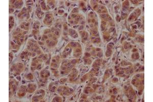 IHC image of ABIN7148793 diluted at 1:100 and staining in paraffin-embedded human breast cancer performed on a Leica BondTM system.