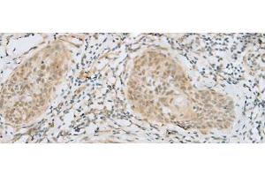 Immunohistochemistry of paraffin-embedded Human esophagus cancer tissue using HELT Polyclonal Antibody at dilution of 1:40(x200) (HELT anticorps)