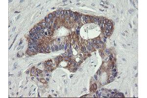 Immunohistochemical staining of paraffin-embedded Adenocarcinoma of Human colon tissue using anti-VBP1 mouse monoclonal antibody. (VBP1 anticorps)