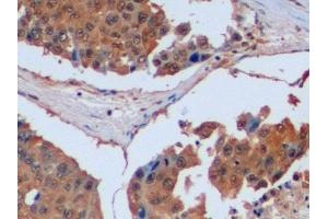 Detection of IDH1 in Human Liver cancer Tissue using Polyclonal Antibody to Isocitrate Dehydrogenase 1, Soluble (IDH1) (IDH1 anticorps  (AA 74-333))
