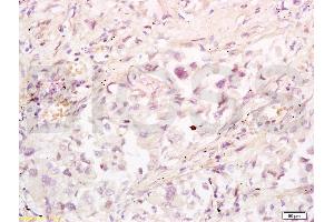 Formalin-fixed and paraffin embedded human lung carcinoma tissue labeled with Anti-RRM1 Polyclonal Antibody, Unconjugated (ABIN731543) at 1:200 followed by conjugation to the secondary antibody, (SP-0023), and DAB staining (RRM1 anticorps  (AA 733-778))