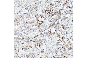 Immunohistochemistry of paraffin-embedded human oophoroma using  antibody (ABIN6131166, ABIN6136417, ABIN6136418 and ABIN6223845) at dilution of 1:100 (40x lens).