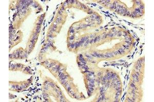 IHC image of ABIN7151810 diluted at 1:400 and staining in paraffin-embedded human endometrial cancer performed on a Leica BondTM system.