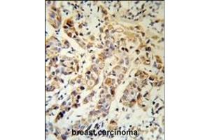 KRT13 Antibody (N-term) (R) IHC analysis in formalin fixed and paraffin embedded human breast carcinoma followed by peroxidase conjugation of the secondary antibody and DAB staining. (Cytokeratin 13 anticorps  (N-Term))