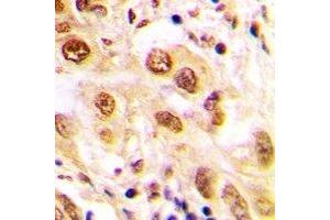 Immunohistochemical analysis of JUND (pS255) staining in human lung cancer formalin fixed paraffin embedded tissue section.