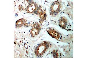 Immunohistochemistry of paraffin-embedded human breast carcinoma using Phospho-YWHAZ-S58 antibody (ABIN2987575). (14-3-3 zeta anticorps  (pSer58))