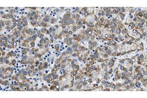 ABIN6274605 at 1/100 staining Human liver cancer tissue by IHC-P. (Cadherin 8 anticorps  (Internal Region))