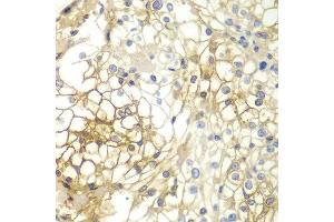 Immunohistochemistry of paraffin-embedded human kidney cancer using SDC1 antibody at dilution of 1:200 (400x lens). (Syndecan 1 anticorps)