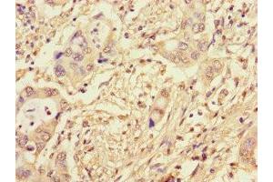 Immunohistochemistry of paraffin-embedded human pancreatic cancer using ABIN7164173 at dilution of 1:100 (CWC22 anticorps  (AA 360-623))