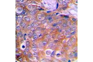 Immunohistochemical analysis of Cortactin staining in human breast cancer formalin fixed paraffin embedded tissue section.