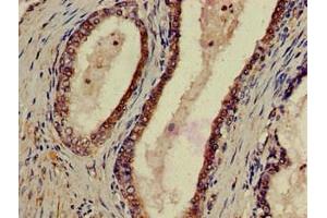 Immunohistochemistry of paraffin-embedded human prostate cancer using ABIN7162439 at dilution of 1:100 (P2RX1 anticorps  (AA 54-175))