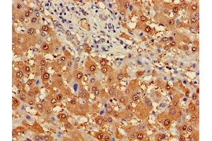 Immunohistochemistry of paraffin-embedded human liver cancer using ABIN7163274 at dilution of 1:100