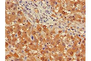 Immunohistochemistry of paraffin-embedded human liver cancer using ABIN7163274 at dilution of 1:100 (Phosphoglucomutase 1 anticorps  (AA 1-562))