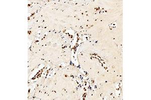 Immunohistochemistry analysis of paraffin embedded human breast cancer using C23 (ABIN7074906) at dilution of 1: 550