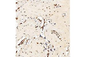 Immunohistochemistry analysis of paraffin embedded human breast cancer using C23 (ABIN7074906) at dilution of 1: 550 (Nucleolin anticorps)