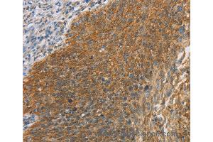 Immunohistochemistry of Human breast cancer using MAPK6 Polyclonal Antibody at dilution of 1:40 (MAPK6 anticorps)