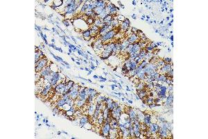 Immunohistochemistry of paraffin-embedded human colon carcinoma using J Rabbit mAb (ABIN7268036) at dilution of 1:100 (40x lens). (JAK1 anticorps)