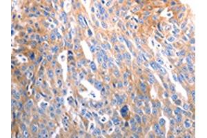 The image on the left is immunohistochemistry of paraffin-embedded Human ovarian cancer tissue using ABIN7192492(SLC44A1 Antibody) at dilution 1/25, on the right is treated with synthetic peptide. (SLC44A1 anticorps)