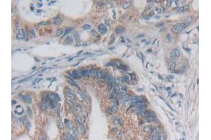 IHC-P analysis of Human Colorectal cancer Tissue, with DAB staining. (Desmoplakin anticorps  (AA 2609-2822))