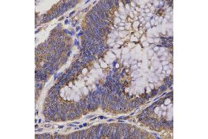 Immunohistochemistry of paraffin-embedded human rectum cancer using EPHX2 antibody at dilution of 1:200 (x40 lens) (EPHX2 anticorps)