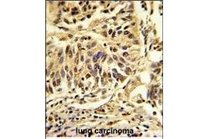 Formalin-fixed and paraffin-embedded human lung carcinoma reacted with CEBPB Antibody (C-term), which was peroxidase-conjugated to the secondary antibody, followed by DAB staining. (CEBPB anticorps  (C-Term))
